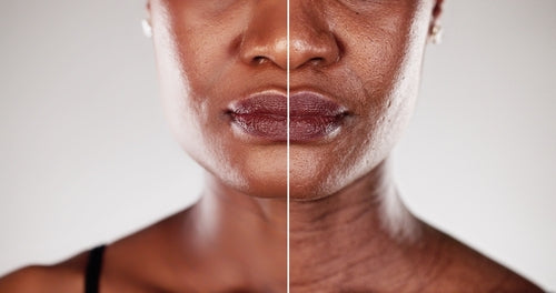 Microdermabrasion